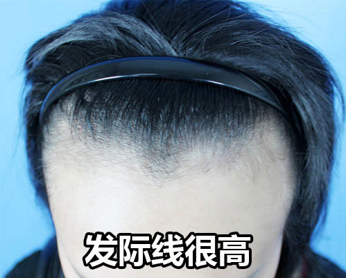 发际线很高的运势好不好