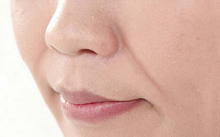 鼻唇沟变浅会有什么影响