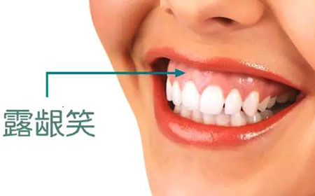 笑露牙龈的面相命运会好吗