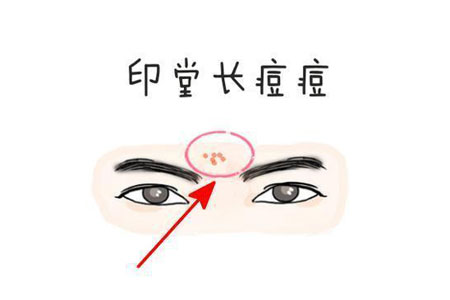 印堂上长痘代表着什么呢