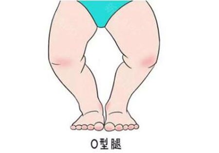 罗圈腿的男人命运如何