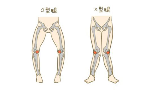罗圈腿的男人命运如何