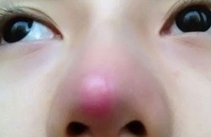 面相鼻子发红是什么原因